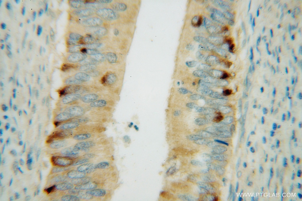 Immunohistochemistry (IHC) staining of human colon cancer tissue using CBR3 Polyclonal antibody (15619-1-AP)