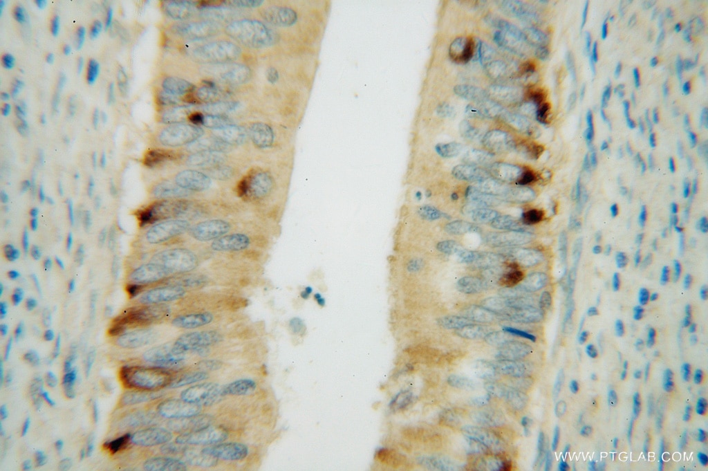 Immunohistochemistry (IHC) staining of human colon cancer tissue using CBR3 Polyclonal antibody (15619-1-AP)