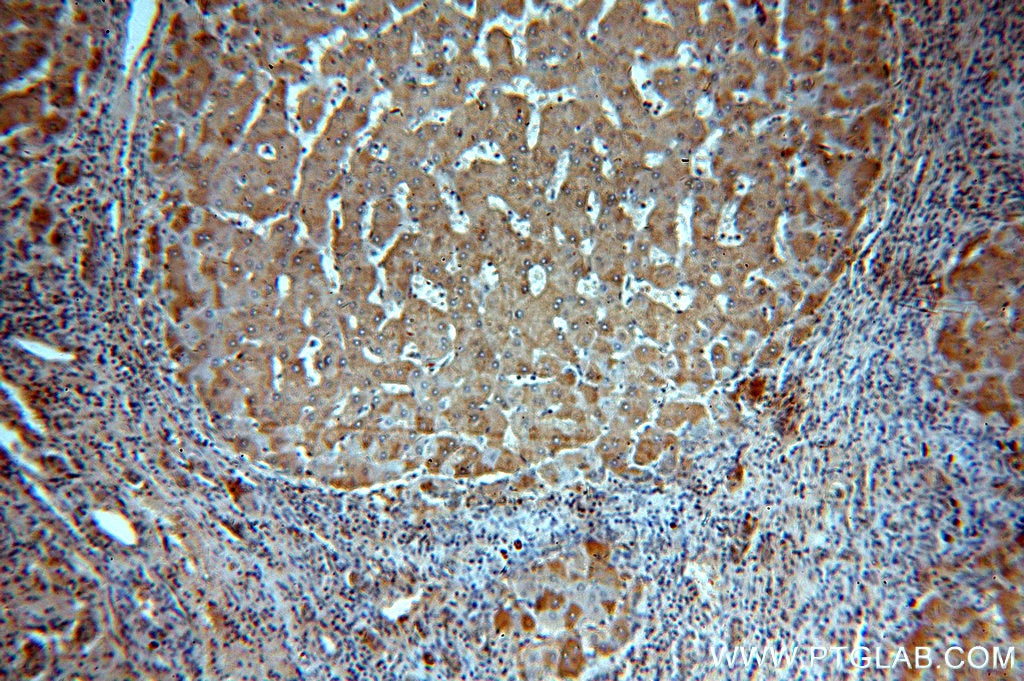Immunohistochemistry (IHC) staining of human hepatocirrhosis tissue using CBR4 Polyclonal antibody (13725-1-AP)