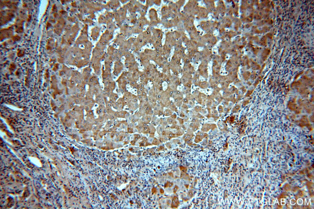 Immunohistochemistry (IHC) staining of human hepatocirrhosis tissue using CBR4 Polyclonal antibody (13725-1-AP)