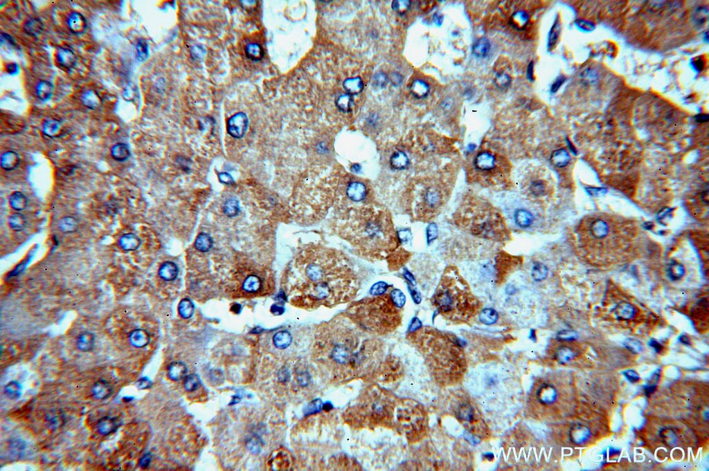 Immunohistochemistry (IHC) staining of human hepatocirrhosis tissue using CBR4 Polyclonal antibody (13725-1-AP)