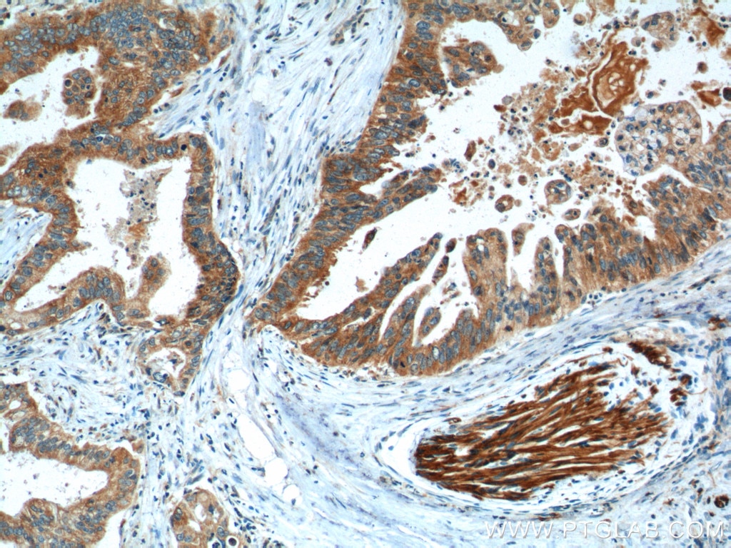 Immunohistochemistry (IHC) staining of human pancreas cancer tissue using CBS Polyclonal antibody (14787-1-AP)