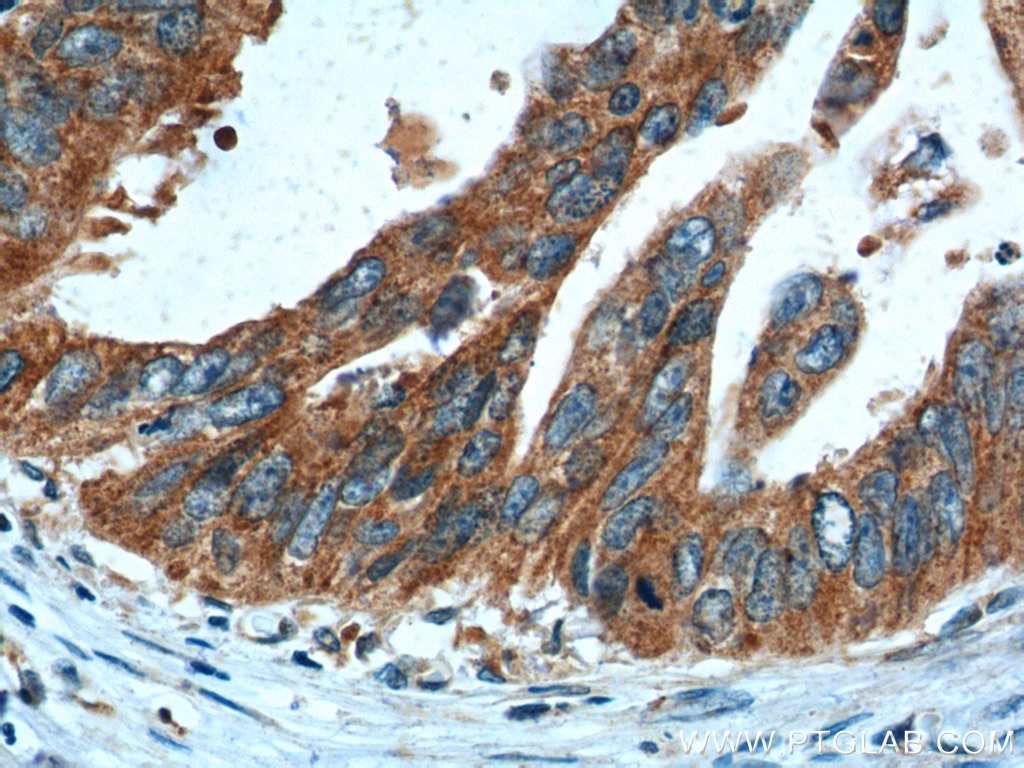 Immunohistochemistry (IHC) staining of human pancreas cancer tissue using CBS Polyclonal antibody (14787-1-AP)