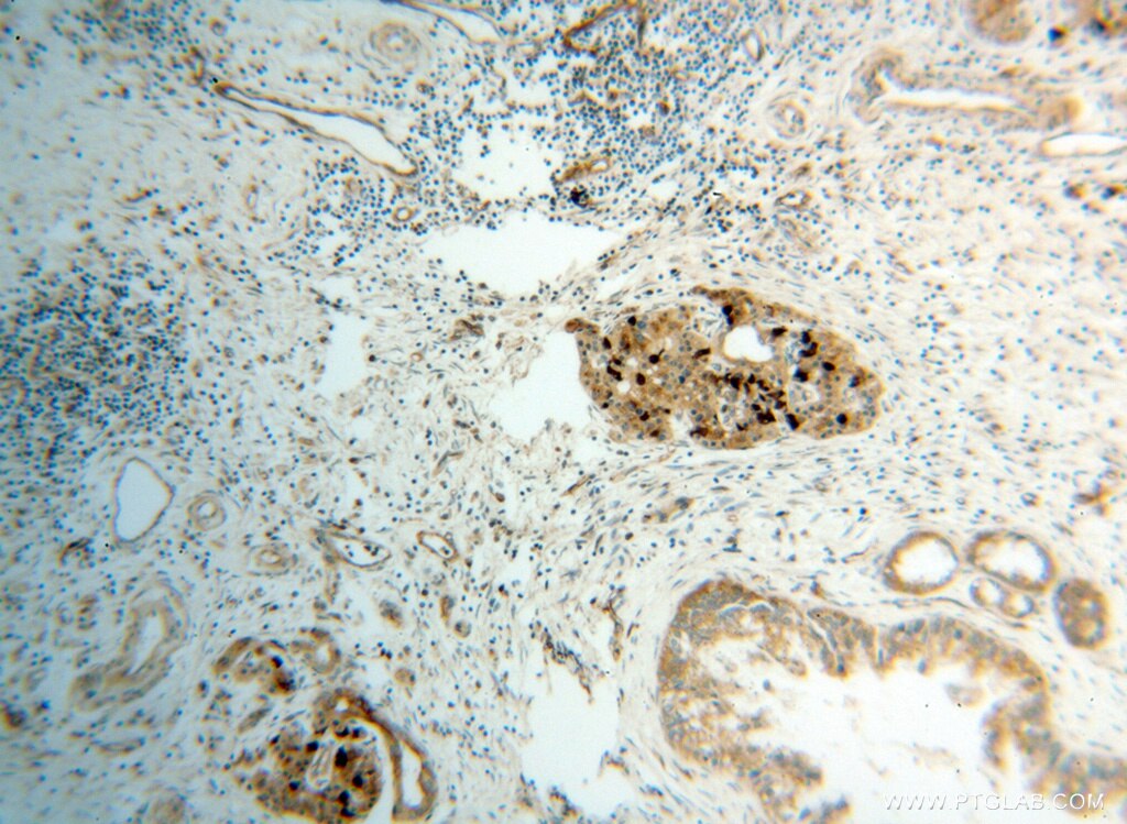 Immunohistochemistry (IHC) staining of human pancreas cancer tissue using CBS Polyclonal antibody (14787-1-AP)