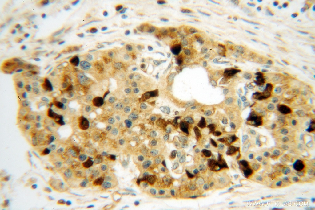 IHC staining of human pancreas cancer using 14787-1-AP