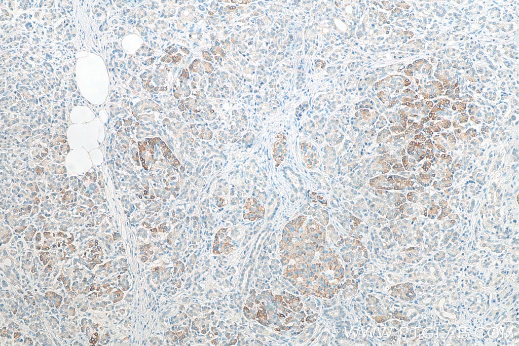 Immunohistochemistry (IHC) staining of human pancreas cancer tissue using CBS Monoclonal antibody (67861-1-Ig)