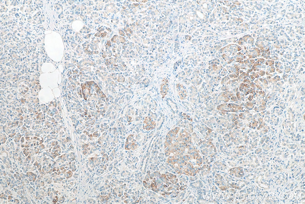 IHC staining of human pancreas cancer using 67861-1-Ig