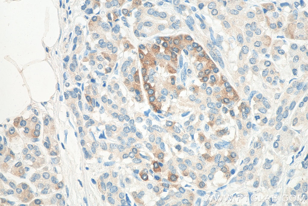 Immunohistochemistry (IHC) staining of human pancreas cancer tissue using CBS Monoclonal antibody (67861-1-Ig)