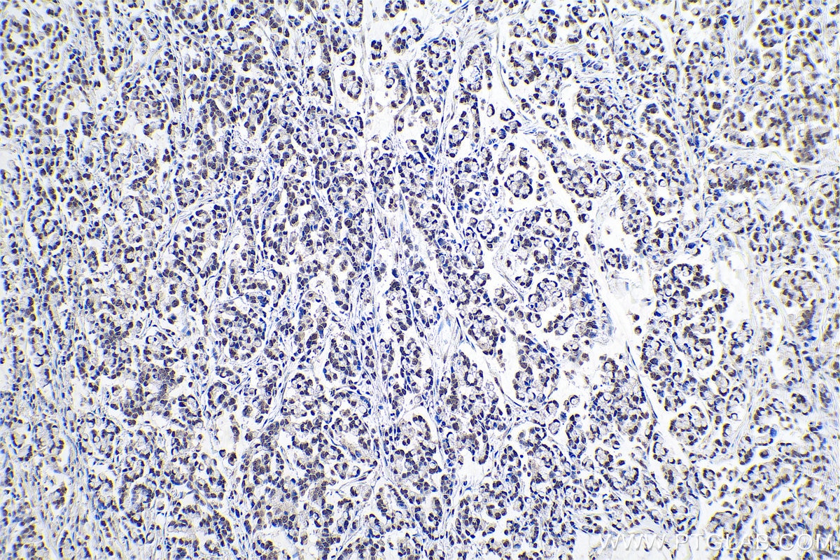 Immunohistochemistry (IHC) staining of human colon cancer tissue using CBX1 Polyclonal antibody (10241-2-AP)