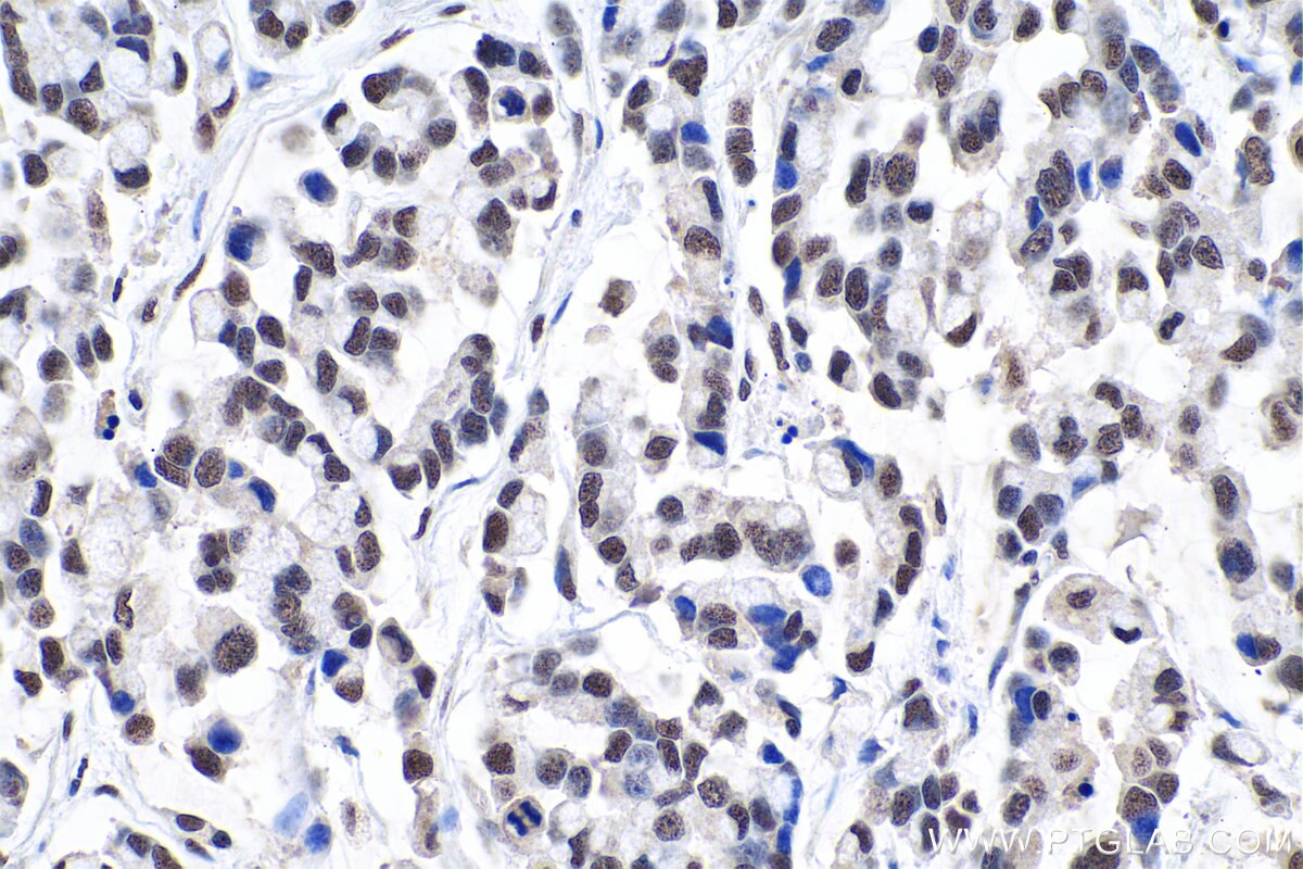 Immunohistochemistry (IHC) staining of human colon cancer tissue using CBX1 Polyclonal antibody (10241-2-AP)