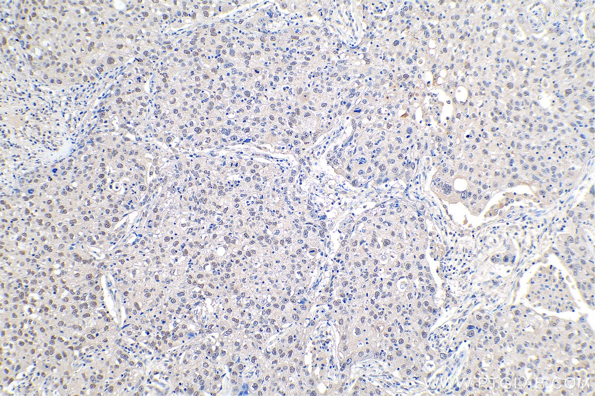IHC staining of human lung cancer using 10241-2-AP