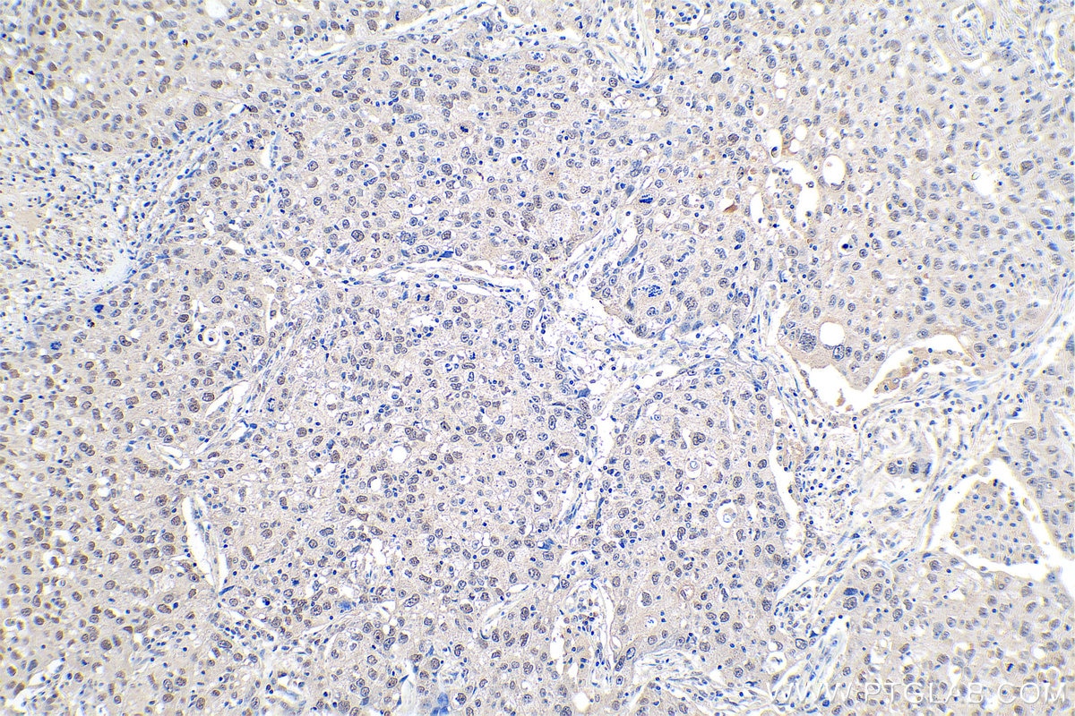 Immunohistochemistry (IHC) staining of human lung cancer tissue using CBX1 Polyclonal antibody (10241-2-AP)