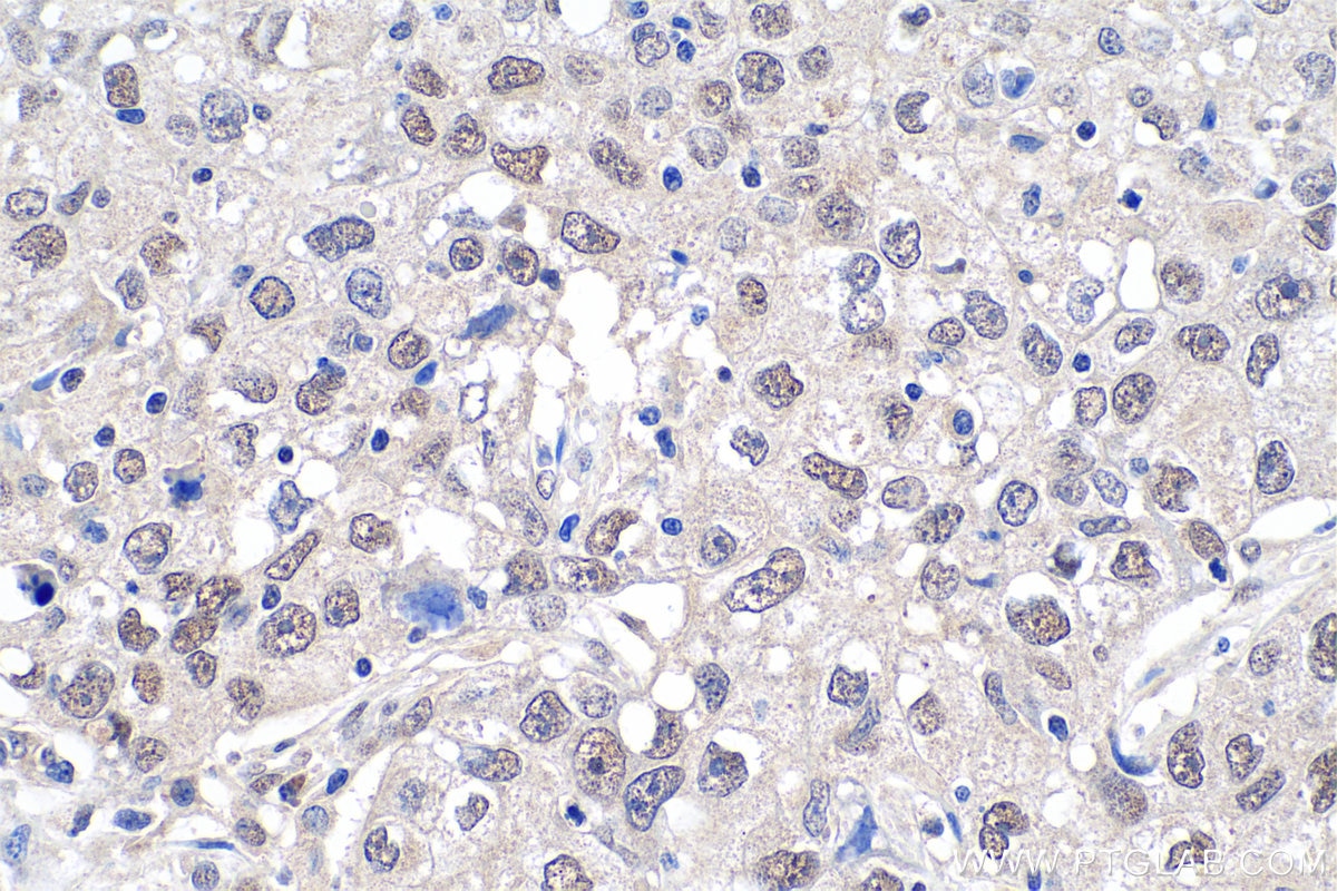 Immunohistochemistry (IHC) staining of human lung cancer tissue using CBX1 Polyclonal antibody (10241-2-AP)