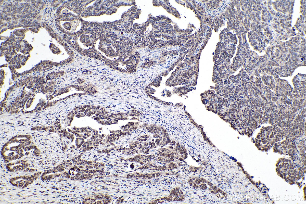 IHC staining of human ovary tumor using 10241-2-AP