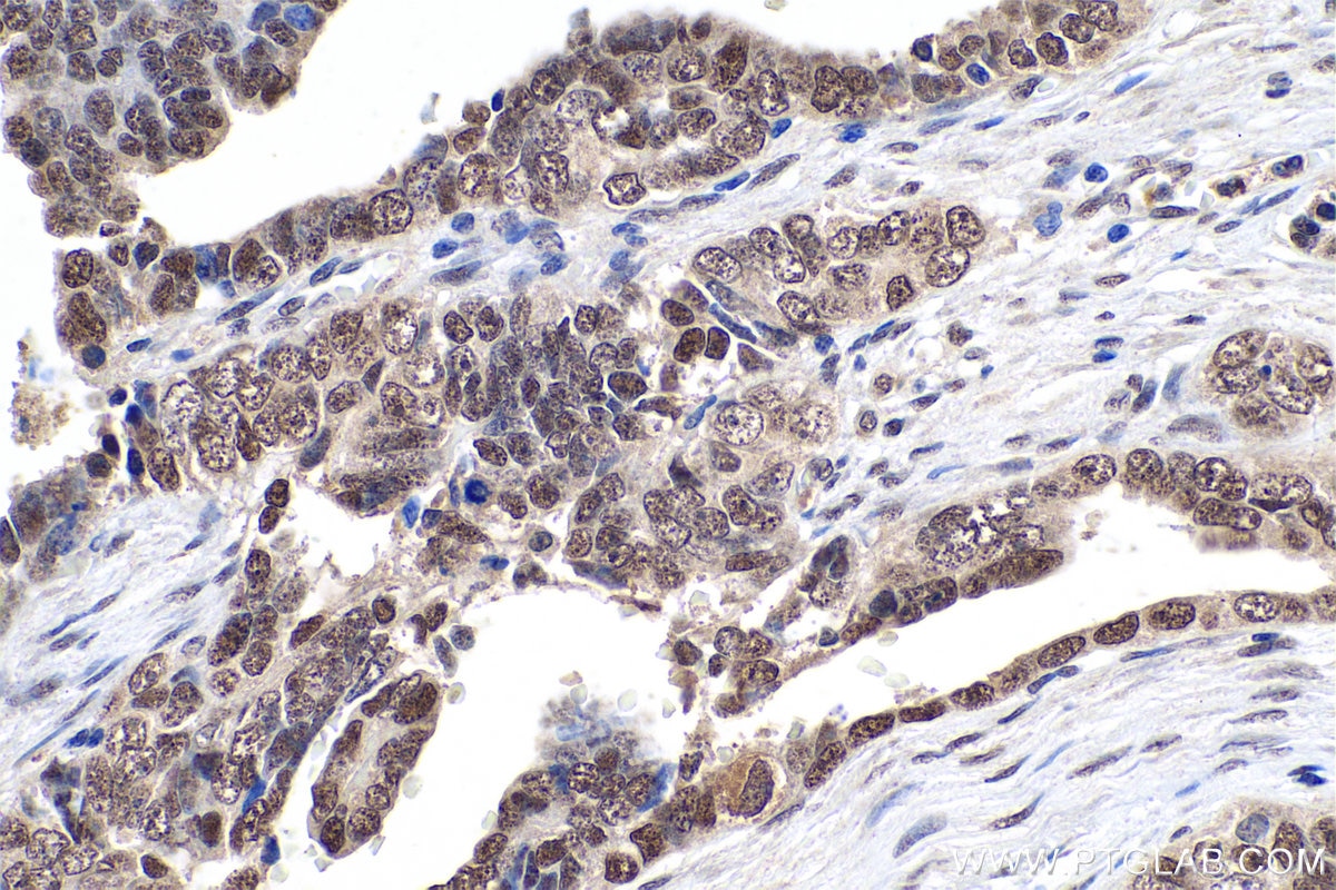 Immunohistochemistry (IHC) staining of human ovary tumor tissue using CBX1 Polyclonal antibody (10241-2-AP)