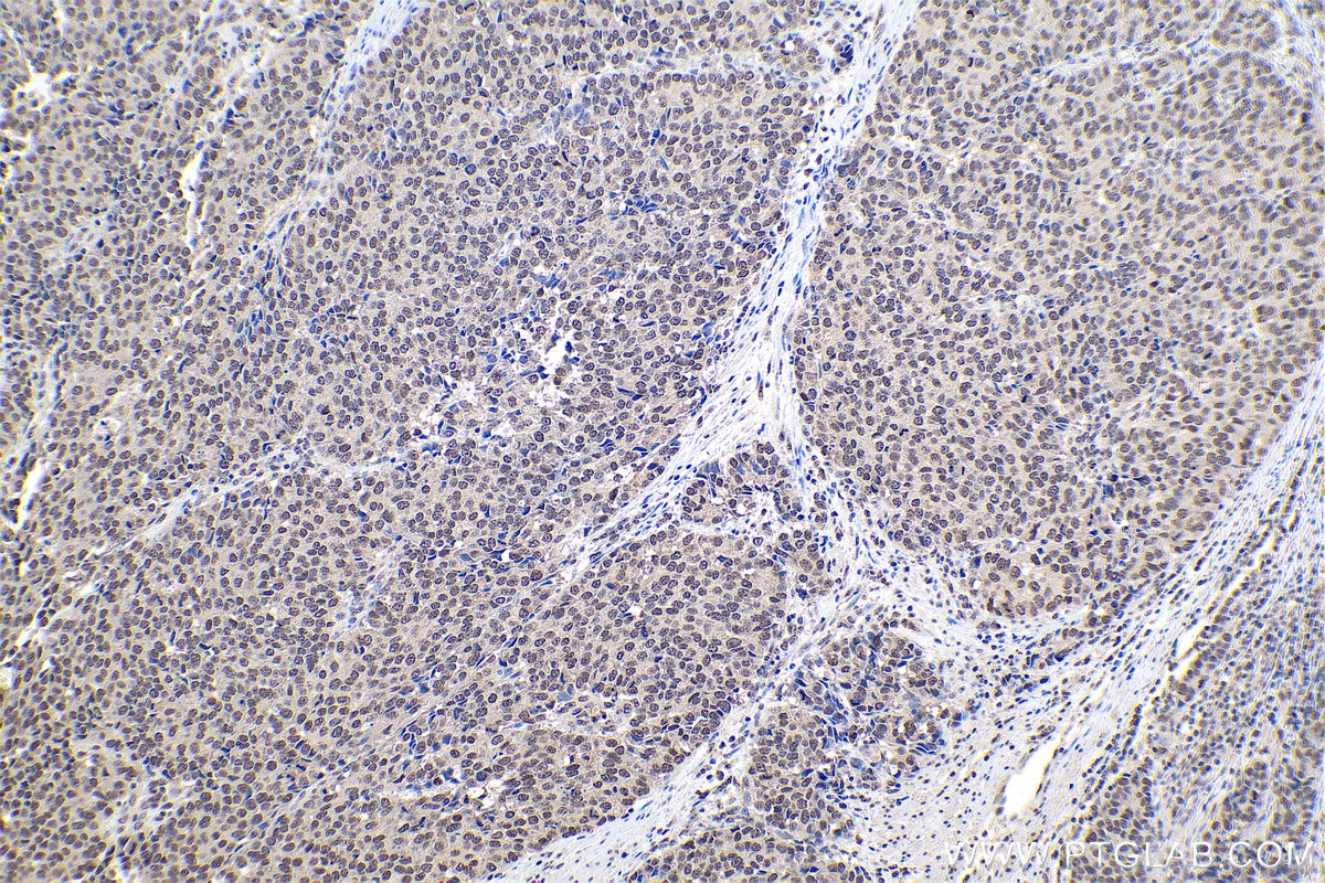 Immunohistochemistry (IHC) staining of human stomach cancer tissue using CBX1 Polyclonal antibody (10241-2-AP)