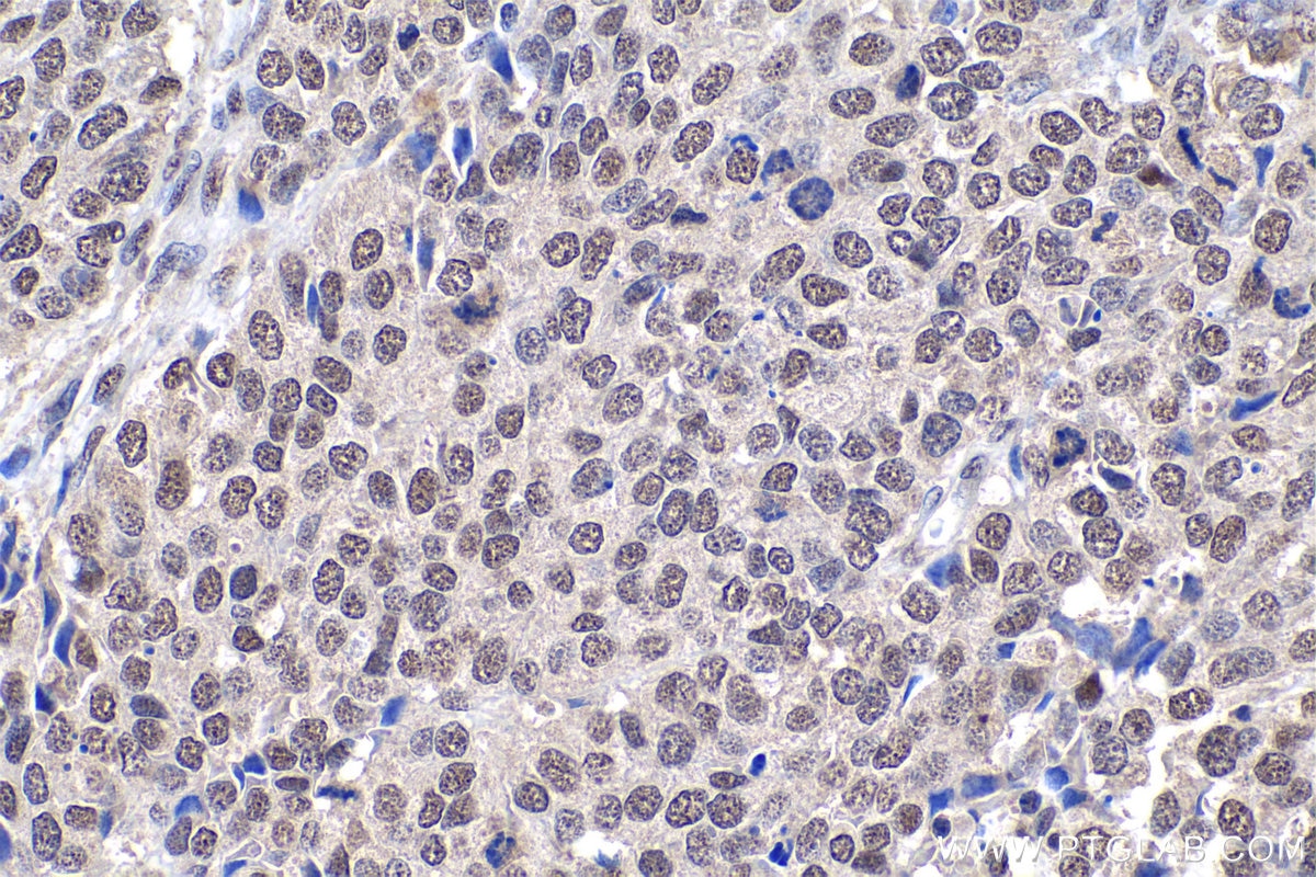 IHC staining of human stomach cancer using 10241-2-AP