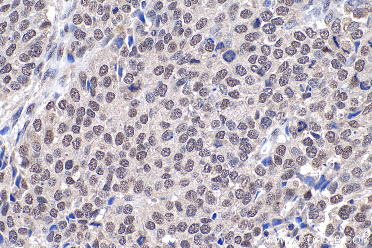 Immunohistochemistry (IHC) staining of human stomach cancer tissue using CBX1 Polyclonal antibody (10241-2-AP)