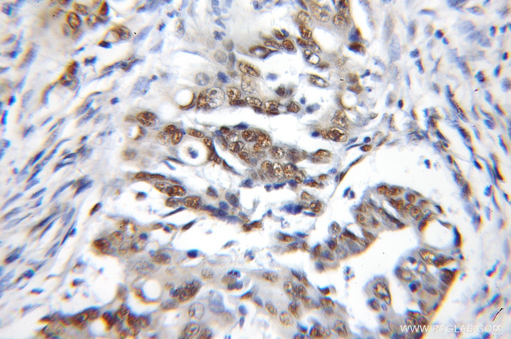 Immunohistochemistry (IHC) staining of human colon cancer tissue using CBX3 Polyclonal antibody (11650-2-AP)