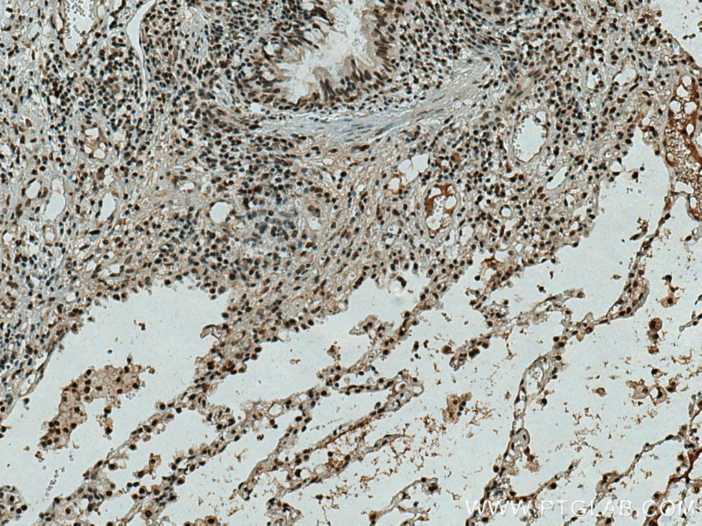 Immunohistochemistry (IHC) staining of human lung cancer tissue using CBX5 Polyclonal antibody (11831-1-AP)