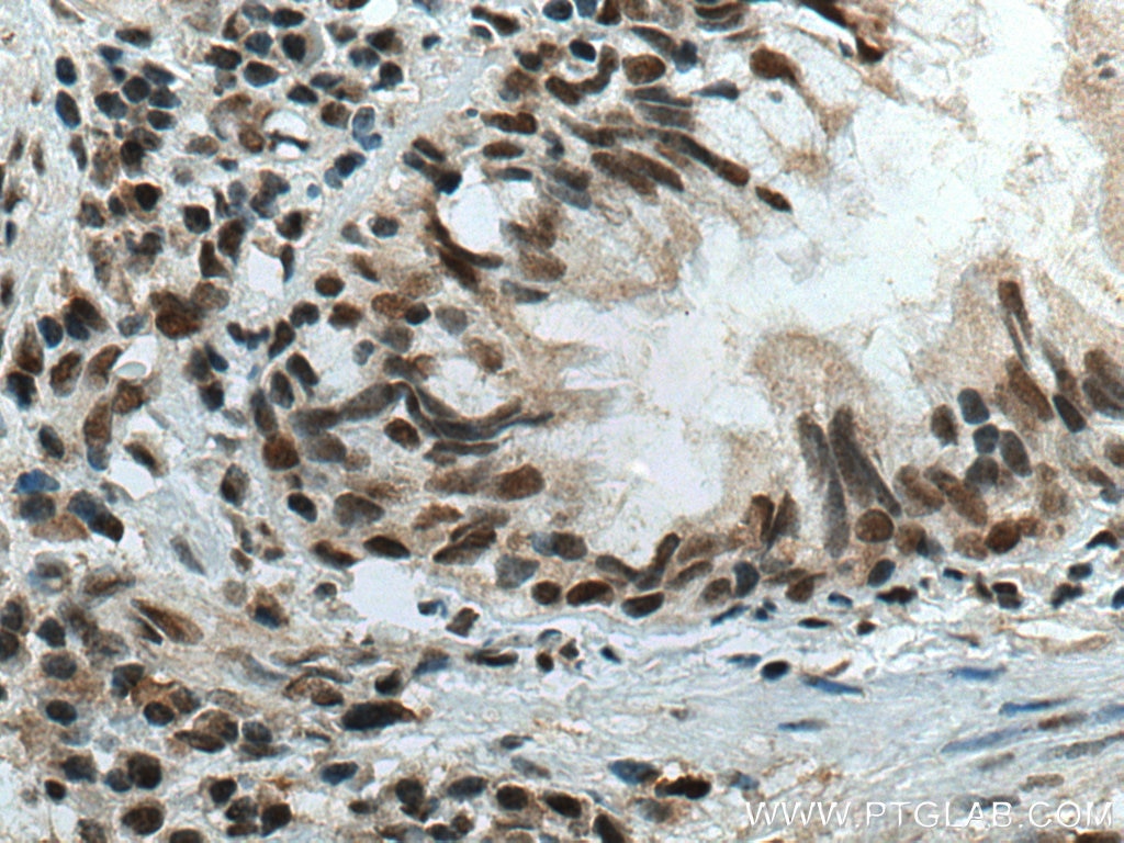 Immunohistochemistry (IHC) staining of human lung cancer tissue using CBX5 Polyclonal antibody (11831-1-AP)