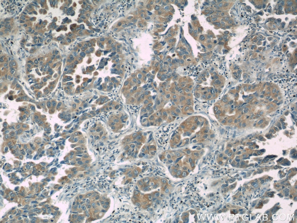 Immunohistochemistry (IHC) staining of human lung cancer tissue using CC2D2A Polyclonal antibody (22293-1-AP)