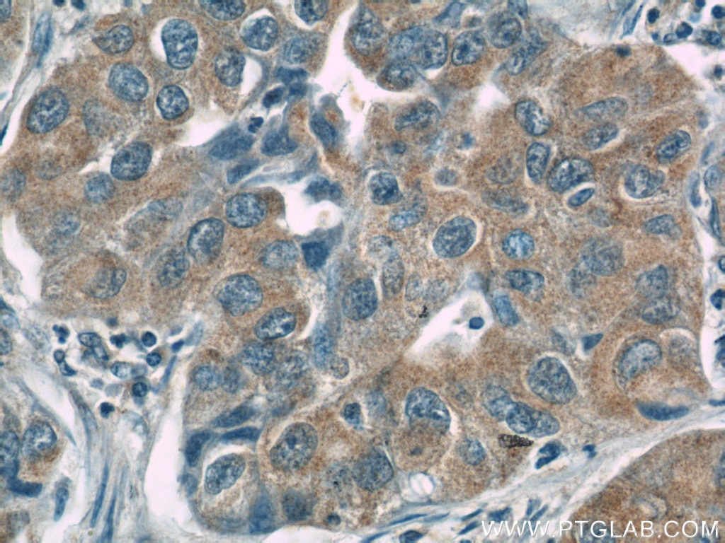 Immunohistochemistry (IHC) staining of human lung cancer tissue using CC2D2A Polyclonal antibody (22293-1-AP)