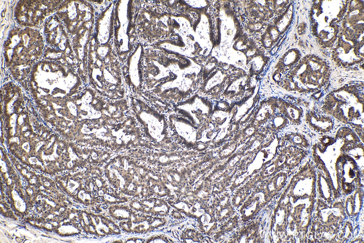 Immunohistochemistry (IHC) staining of human breast cancer tissue using CCAR1 Polyclonal antibody (25232-1-AP)
