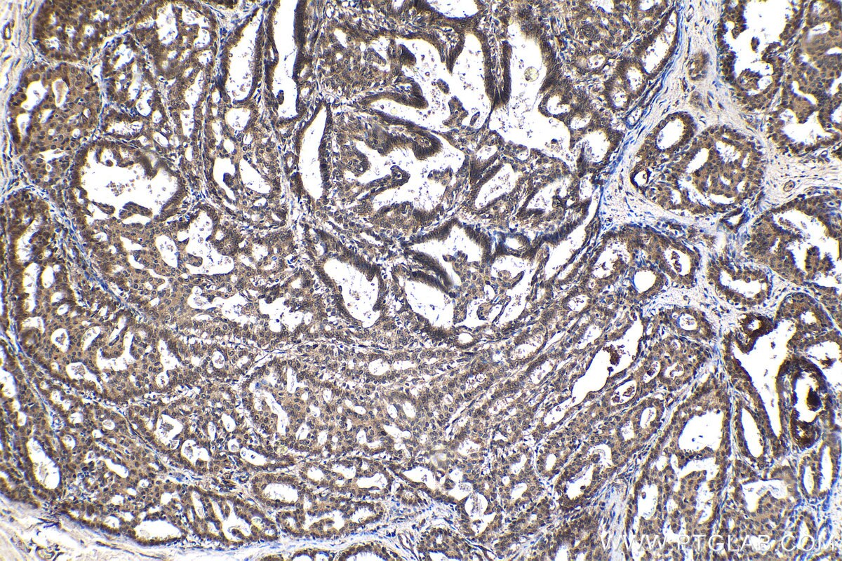 Immunohistochemistry (IHC) staining of human breast cancer tissue using CCAR1 Polyclonal antibody (25232-1-AP)