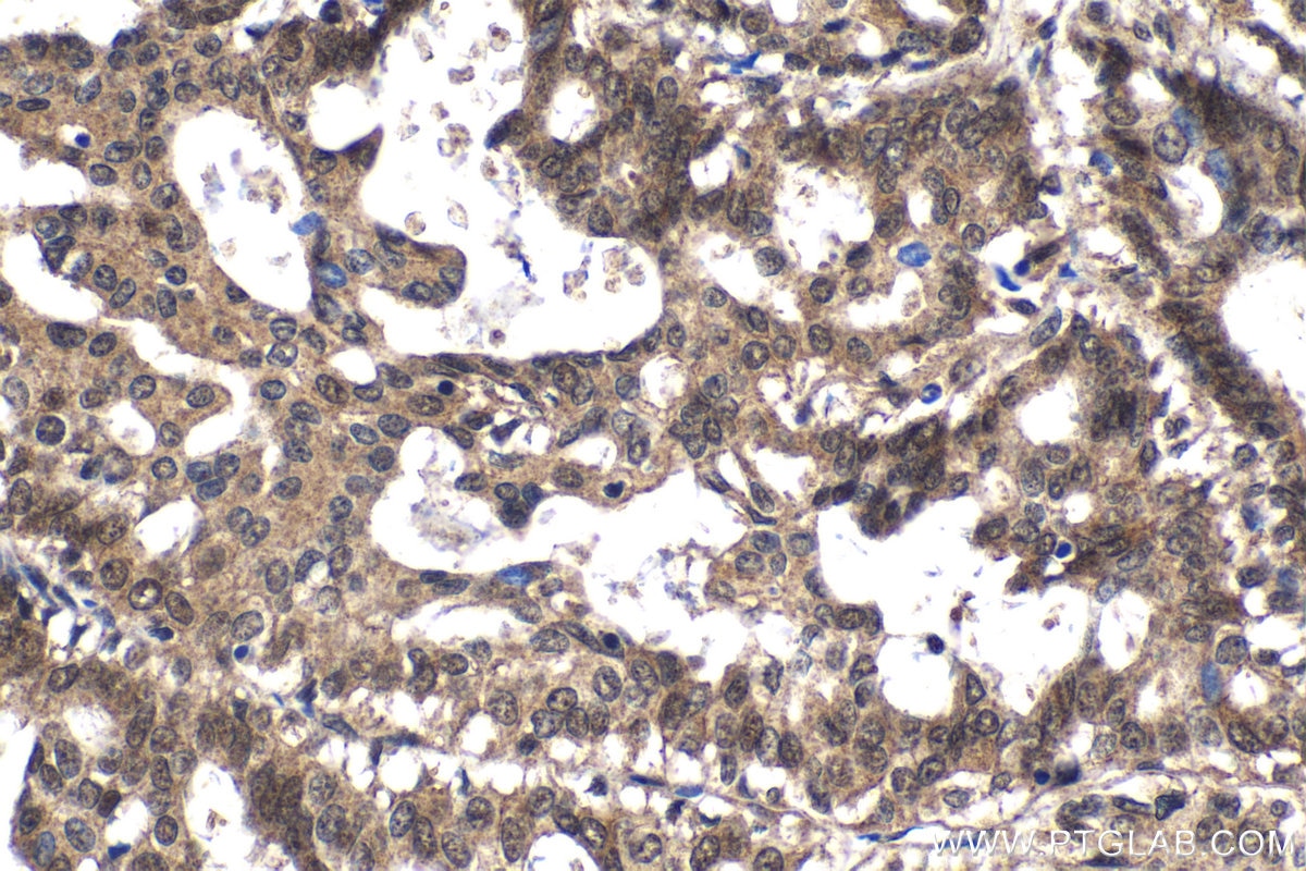 Immunohistochemistry (IHC) staining of human breast cancer tissue using CCAR1 Polyclonal antibody (25232-1-AP)