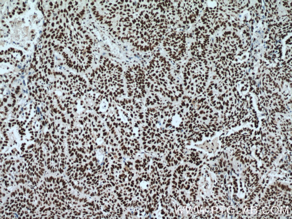 Immunohistochemistry (IHC) staining of human lung cancer tissue using CCAR2 Monoclonal antibody (66497-1-Ig)