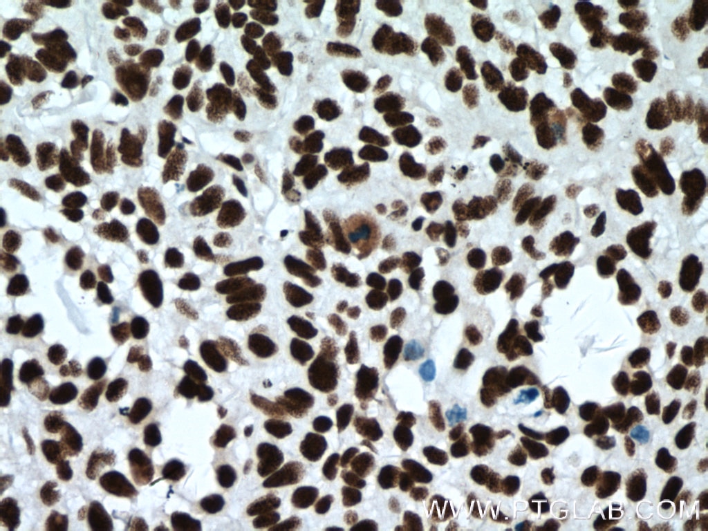 Immunohistochemistry (IHC) staining of human lung cancer tissue using CCAR2 Monoclonal antibody (66497-1-Ig)