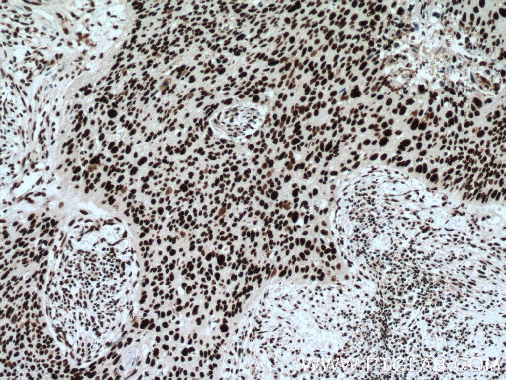 Immunohistochemistry (IHC) staining of human cervical cancer tissue using CCAR2 Monoclonal antibody (66497-1-Ig)