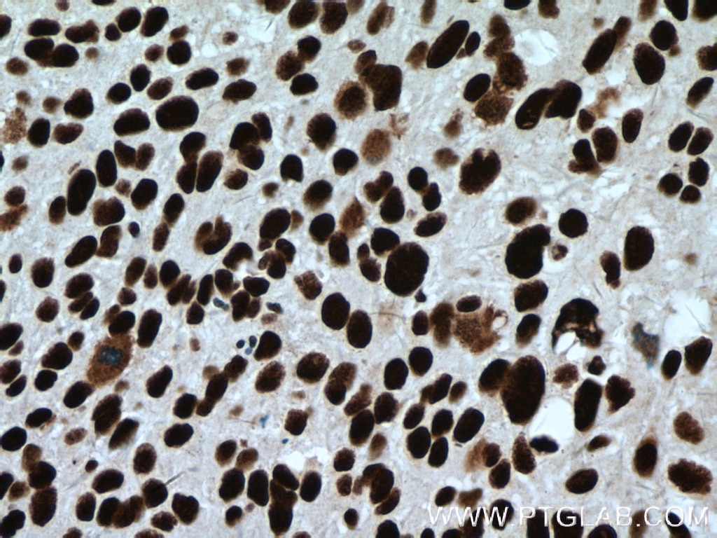 Immunohistochemistry (IHC) staining of human cervical cancer tissue using CCAR2 Monoclonal antibody (66497-1-Ig)