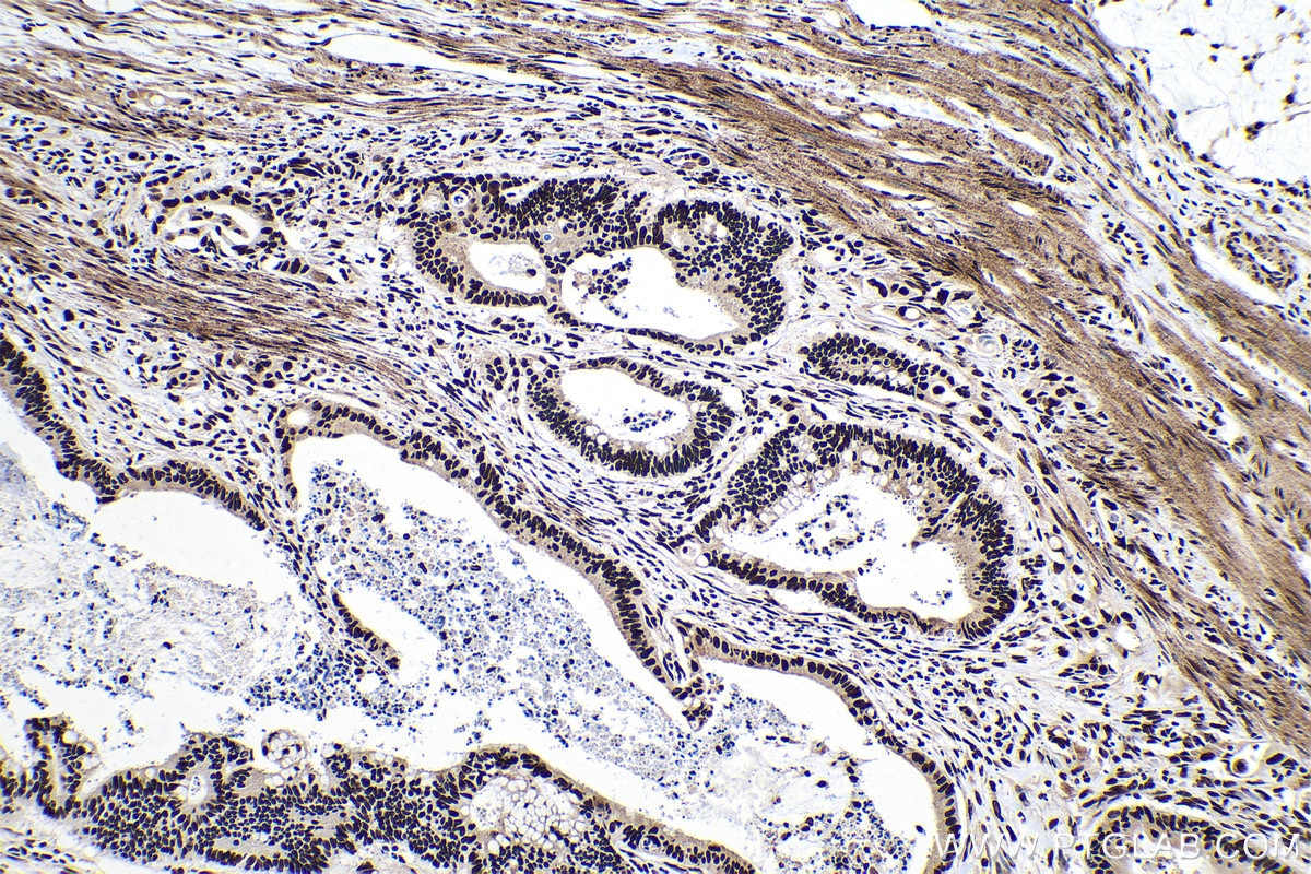 Immunohistochemistry (IHC) staining of human colon cancer tissue using CCAR2 Monoclonal antibody (66497-1-Ig)