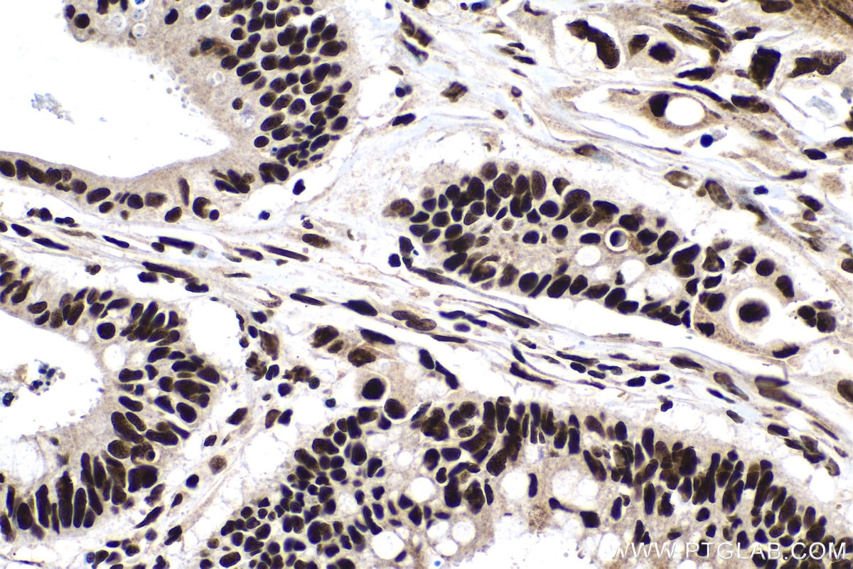 IHC staining of human colon cancer using 66497-1-Ig