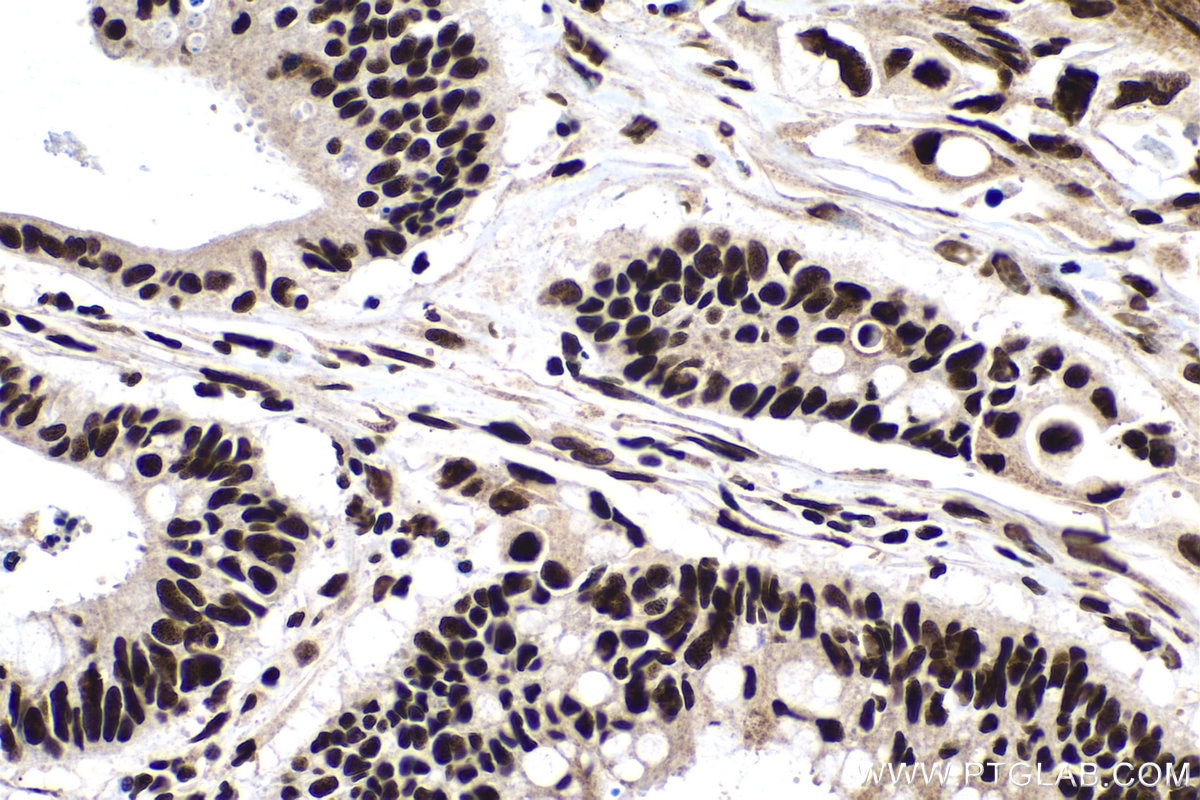 Immunohistochemistry (IHC) staining of human colon cancer tissue using CCAR2 Monoclonal antibody (66497-1-Ig)