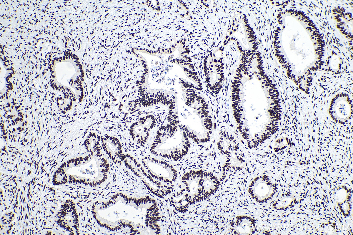 IHC staining of human colon cancer using 66497-1-Ig