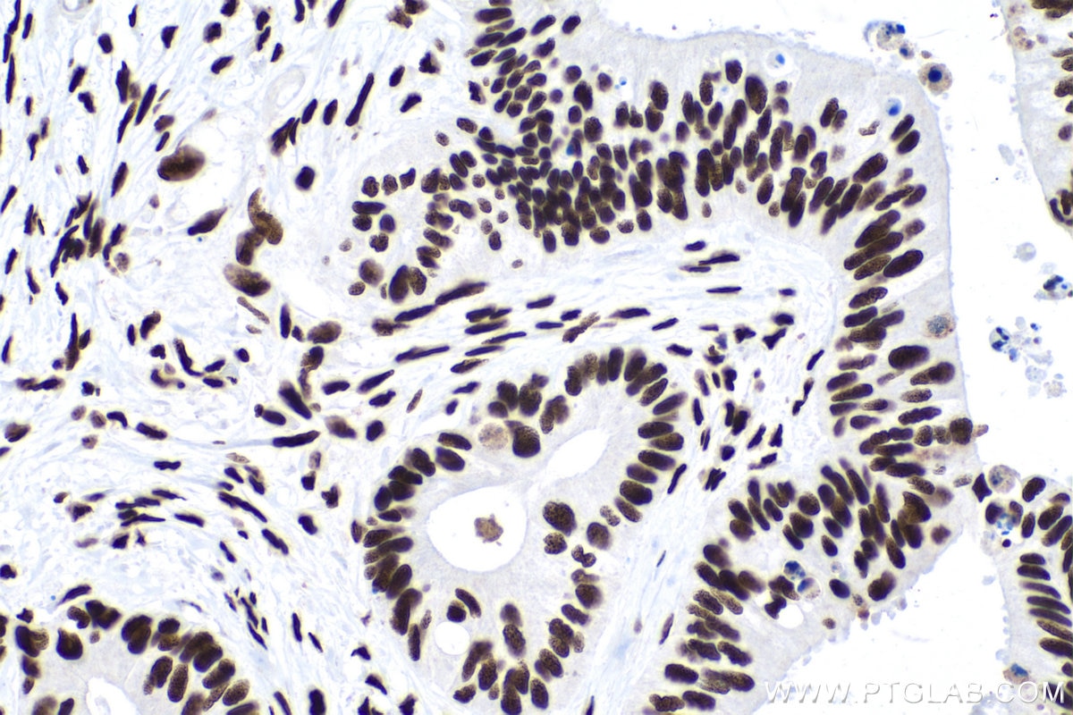 Immunohistochemistry (IHC) staining of human colon cancer tissue using CCAR2 Monoclonal antibody (66497-1-Ig)