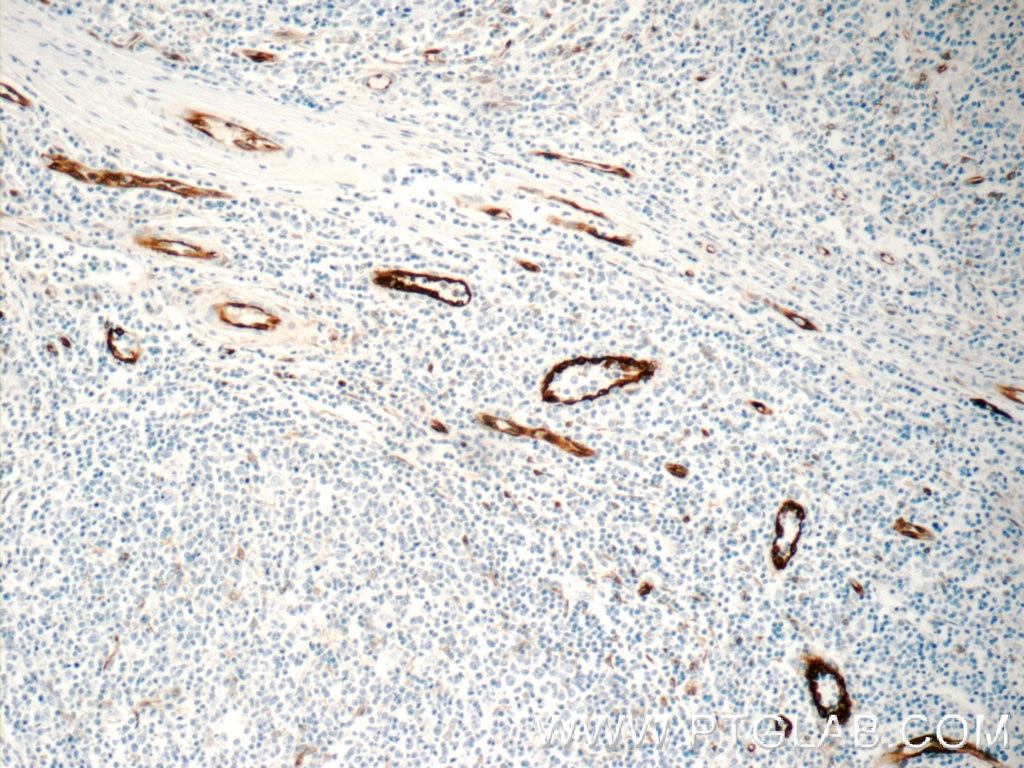 Immunohistochemistry (IHC) staining of human tonsillitis tissue using ACKR2 Polyclonal antibody (11386-1-AP)