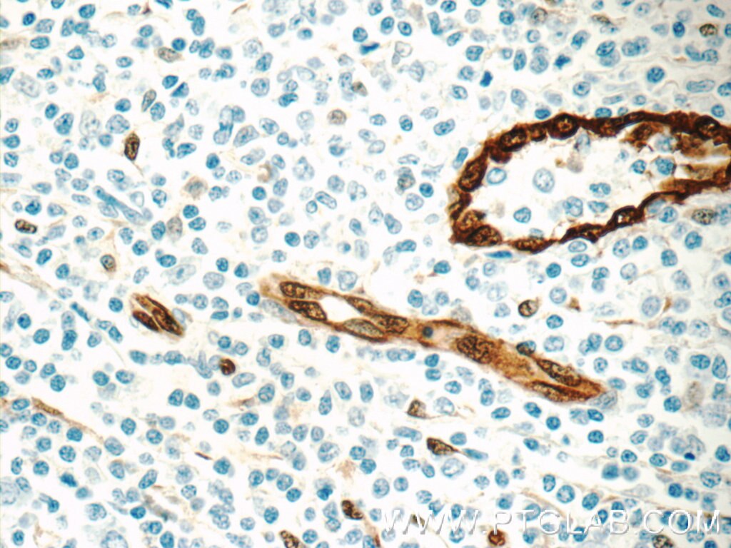 Immunohistochemistry (IHC) staining of human tonsillitis tissue using ACKR2 Polyclonal antibody (11386-1-AP)