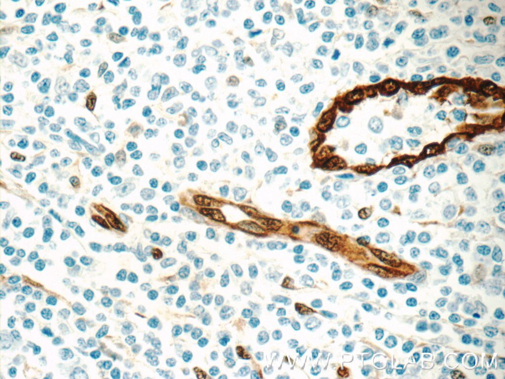 IHC staining of human tonsillitis using 11386-1-AP