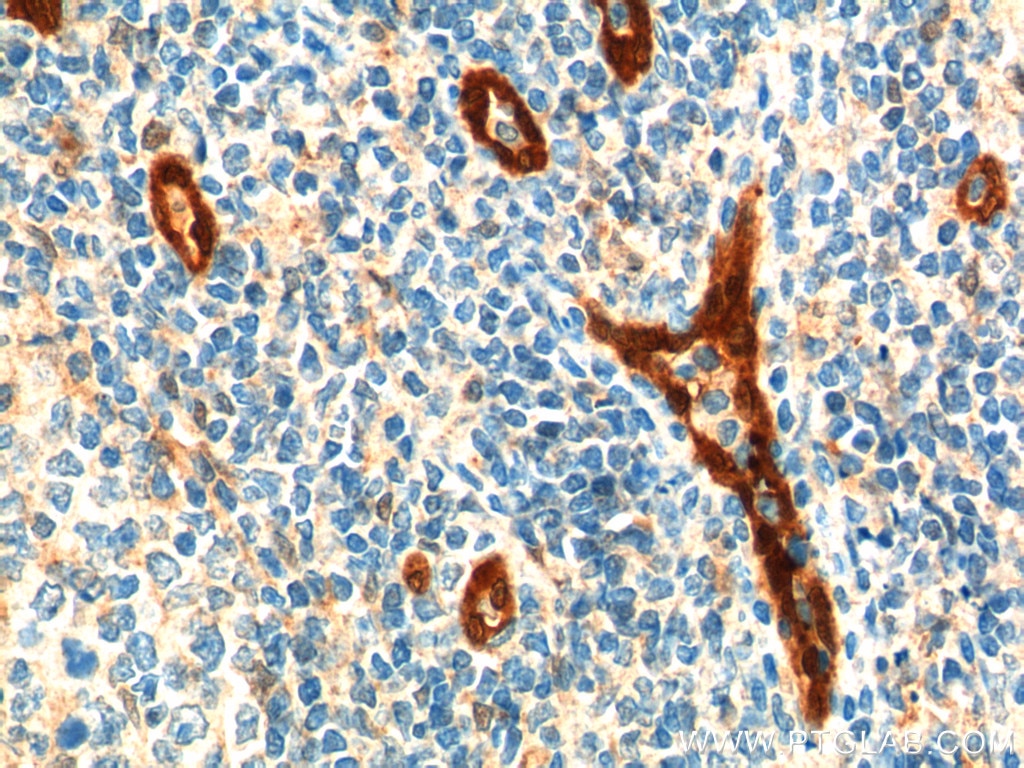 Immunohistochemistry (IHC) staining of human tonsillitis tissue using ACKR2 Monoclonal antibody (60046-1-Ig)