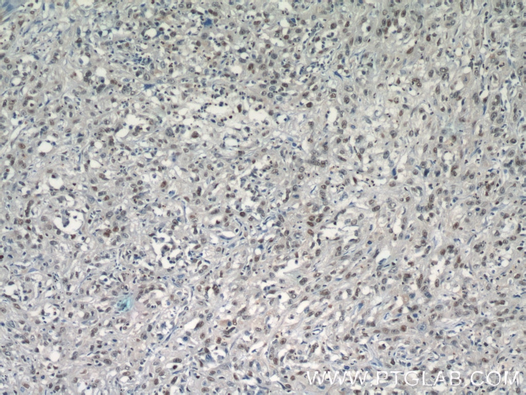 IHC staining of human cervical cancer using 24061-1-AP