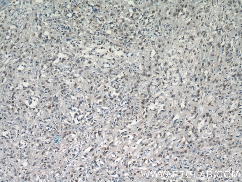 Immunohistochemistry (IHC) staining of human cervical cancer tissue using SGF29 Polyclonal antibody (24061-1-AP)