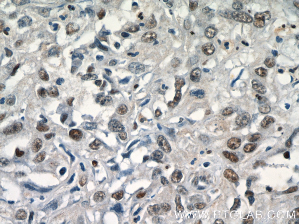 Immunohistochemistry (IHC) staining of human cervical cancer tissue using SGF29 Polyclonal antibody (24061-1-AP)