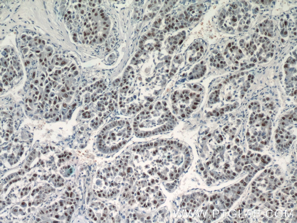 Immunohistochemistry (IHC) staining of human liver cancer tissue using SGF29 Polyclonal antibody (24061-1-AP)