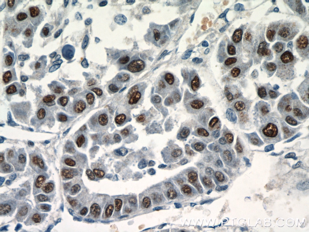 Immunohistochemistry (IHC) staining of human liver cancer tissue using SGF29 Polyclonal antibody (24061-1-AP)