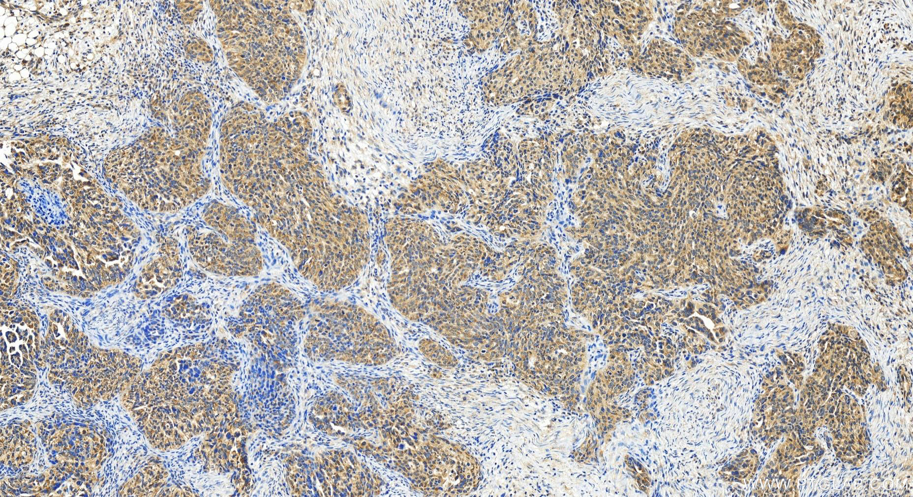 Immunohistochemistry (IHC) staining of human ovary cancer tissue using CCDC115 Polyclonal antibody (20636-1-AP)