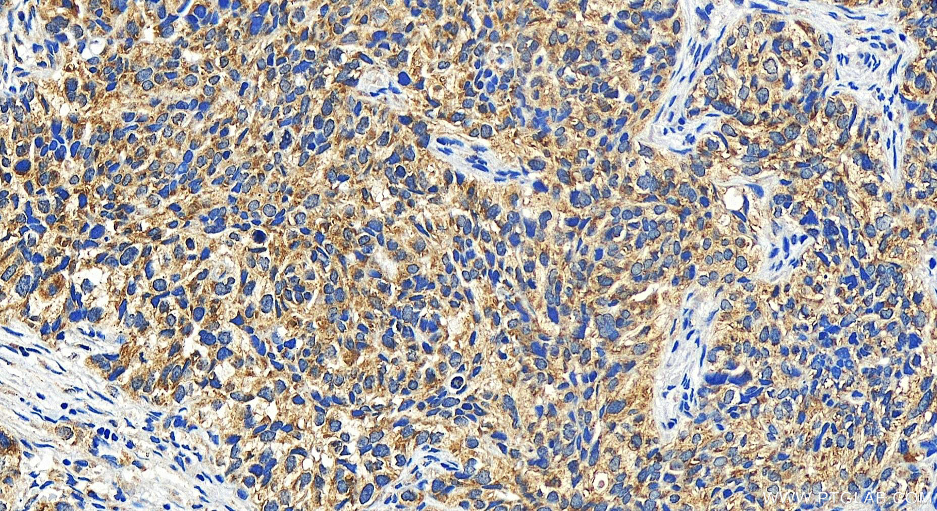 Immunohistochemistry (IHC) staining of human ovary cancer tissue using CCDC115 Polyclonal antibody (20636-1-AP)